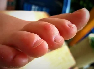بداية تشكل إصبع القدم المطرقية عند الأطفال