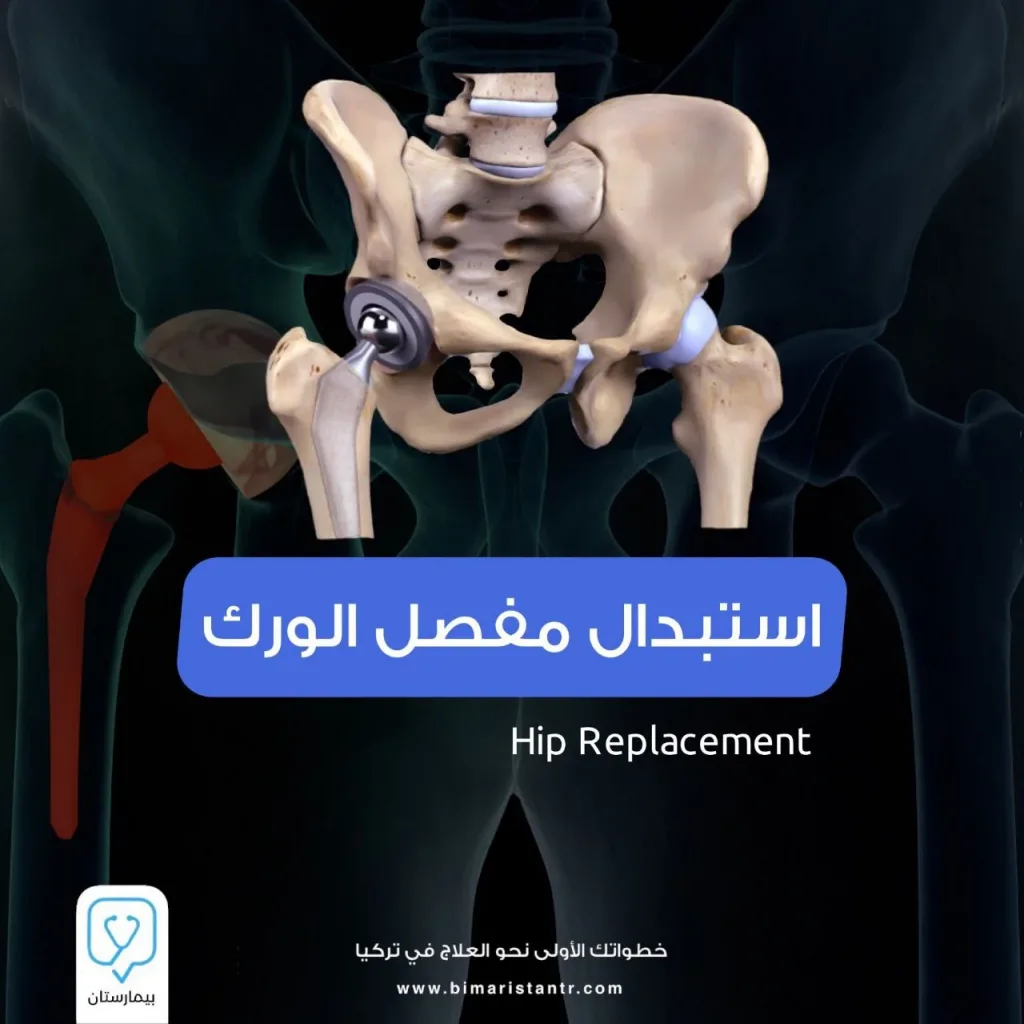 Hip-joint-change operation