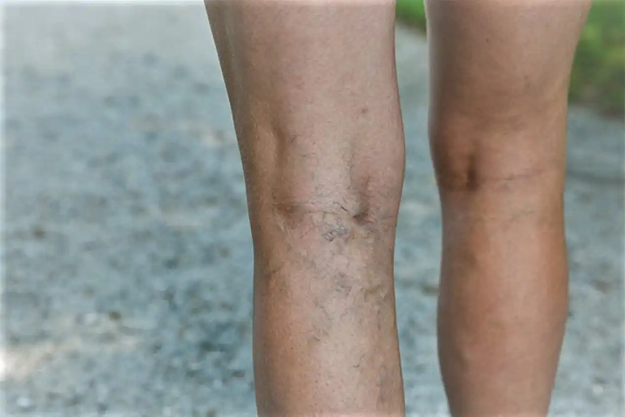 Varicose veins appear clear on the surface of the skin in a blue color when the superficial veins expand