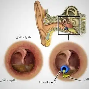 Surgical treatment includes tympanectomy and placement of a tube to drain fluid accumulated in the middle ear due to obstruction of the Eustachian tube