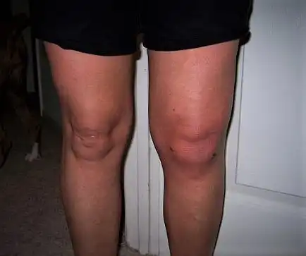 Swelling after knee arthroscopy
