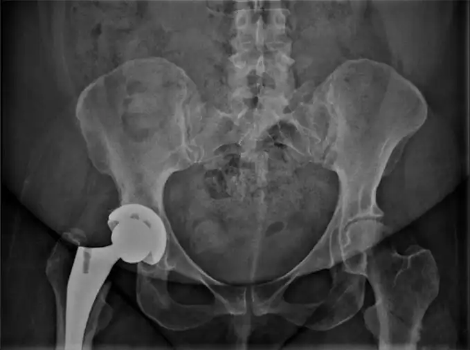 The shape of the hip joint after the replacement surgery