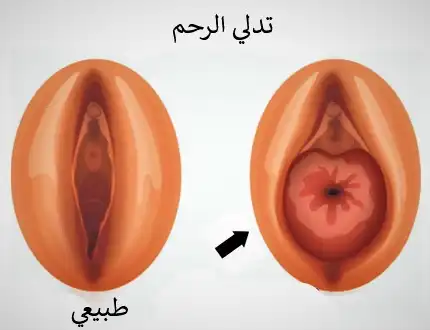 In the case of uterine prolapse, the cervix can be seen in the vagina