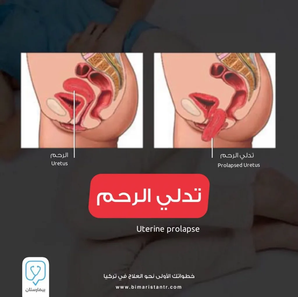 Uterine prolapse - causes, symptoms and treatment methods in Turkey