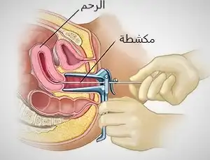 The expansion and curettage of the uterus is done using two instruments, the dilator and the scraper