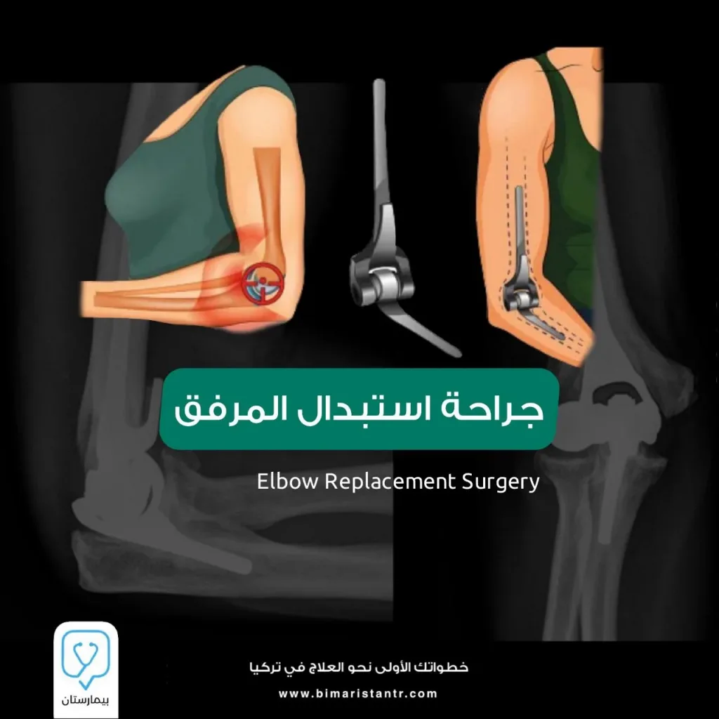 Elbow-replacement surgery