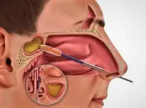 With functional endoscopic sinus surgery, the surgeon can access all the sinuses through the nostril