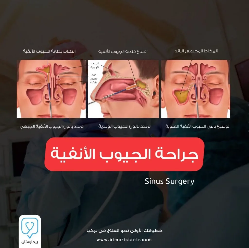 Türkiye'de sinüzit için endoskopik sinüs cerrahisi