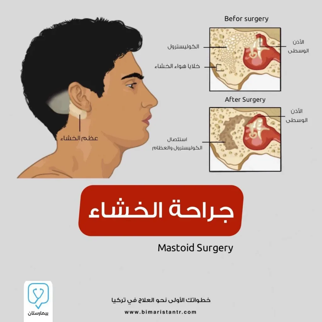 Mastoidectomy - mastoiditis and its symptoms