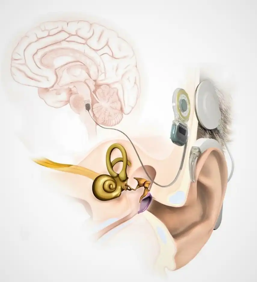 الجهاز المستعمل في عملية زرع جذع الدماغ السمعي في تركيا ويوضع فوق الأذن