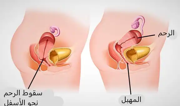 تنتج أعراض هبوط الرحم عن توضع الرحم أسفل مكانه الطبيعي
