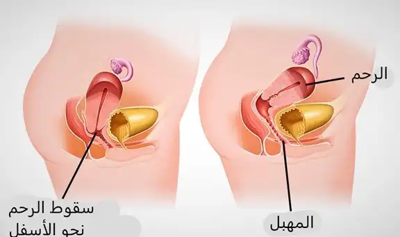 هبوط الرحم شكل المهبل للمتزوجه