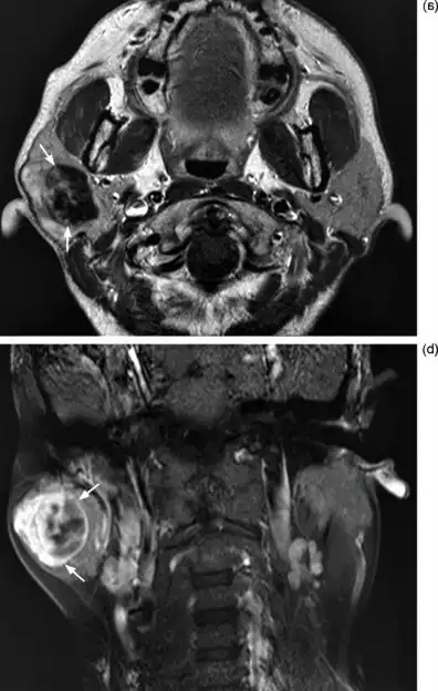The skull of a patient with salivary gland cancer was scanned by magnetic resonance imaging in Turkey, and the image showed a mass in the parotid gland