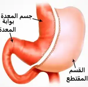 عمليات السمنة بالروبوت