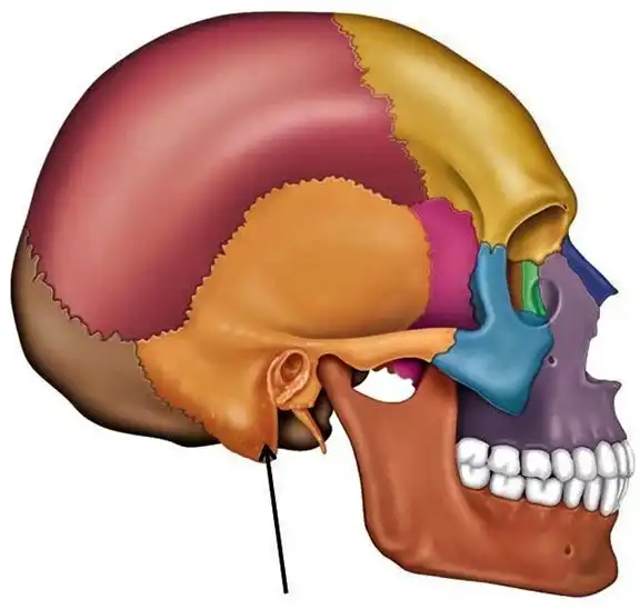 The mastoid bone is a part of the temporal bone located behind the ear