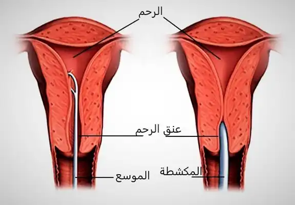 Rahim ağzı önce bir dilatör ile genişletilir ve daha sonra endometrium bir kazıyıcı ile kazınır.