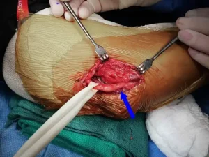 Nerve release during treatment of ulnar nerve entrapment