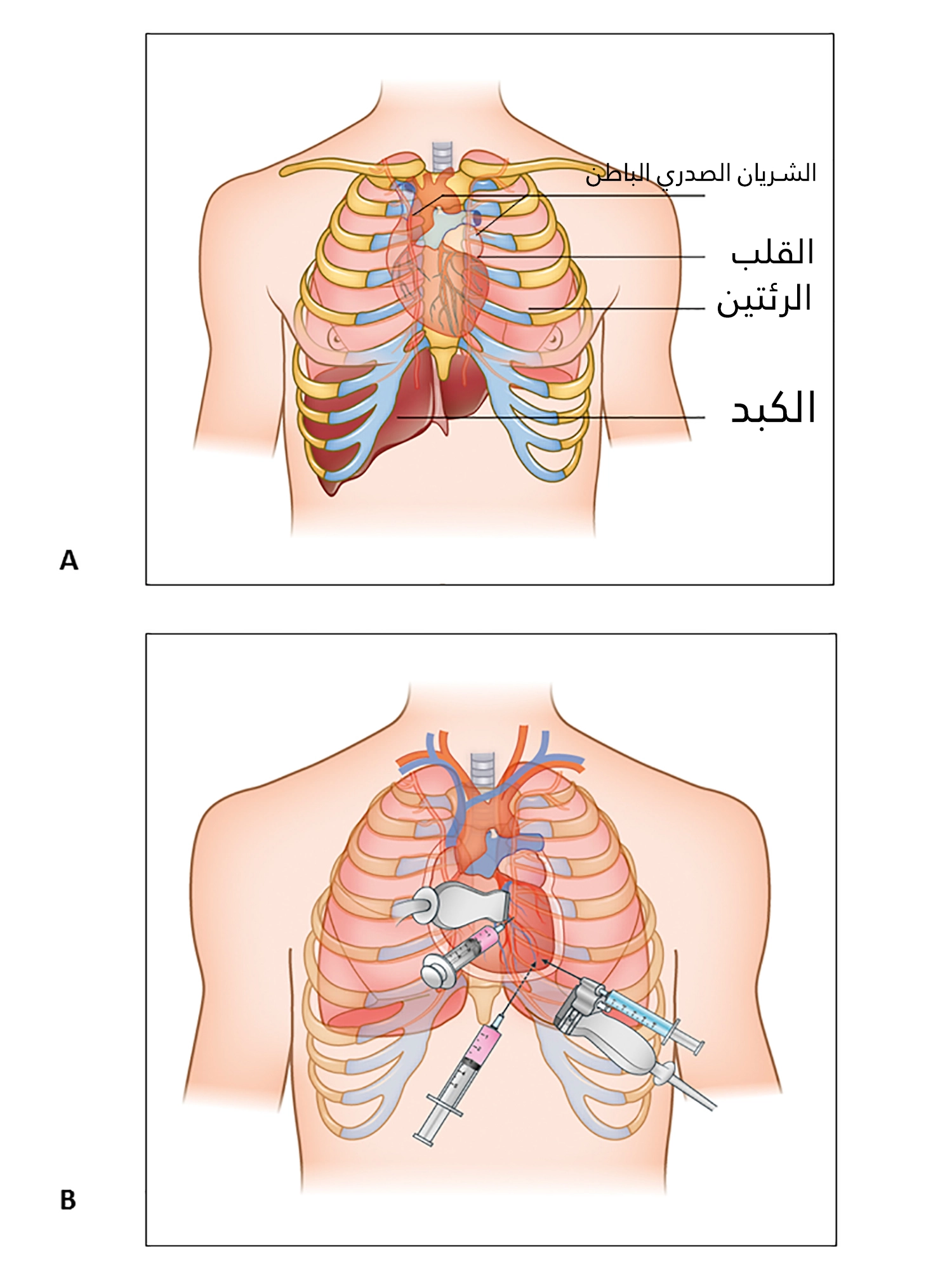 Sometimes pericardiocentesis is curative, as in the case of pericardial effusion