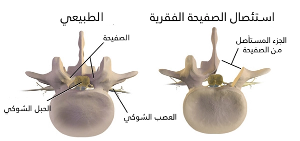 Laminectomy is performed in Turkey in order to relieve pressure on the spinal cord