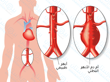 The difference between normal aorta and abdominal aortic aneurysm