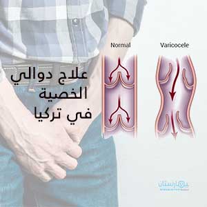 Learn about the latest methods of treating varicocele in Turkey