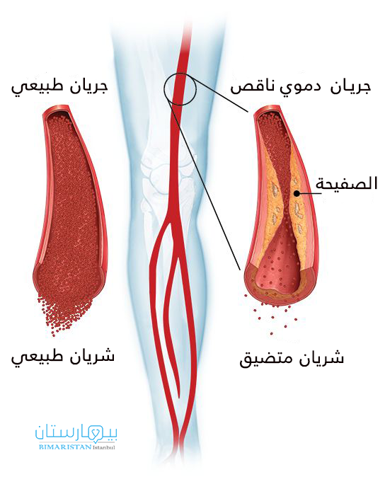 عندما تتشكل الصفيحة العصيدية بسبب تراكم الدهون يتضيق الشريان وتقل كفاءته في نقل كريات الدم الحمراء المحملة بالأوكسجين