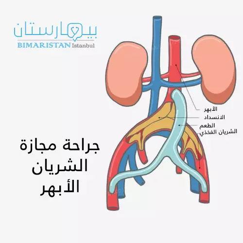 Cerrahi-bypass-arter-aort