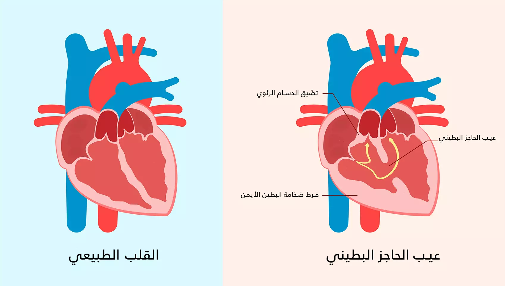 Ventricular septal defect is distinguished from the normal heart by the presence of a hole through which blood passes, which may be associated with pulmonary stenosis and right ventricular hypertrophy.