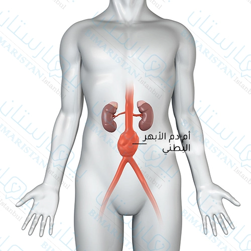 The abdominal aortic aneurysm is located in the ventral part of the aorta