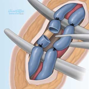 Varicocele can be treated by tying the spermatic vein under the inguinal ligament
