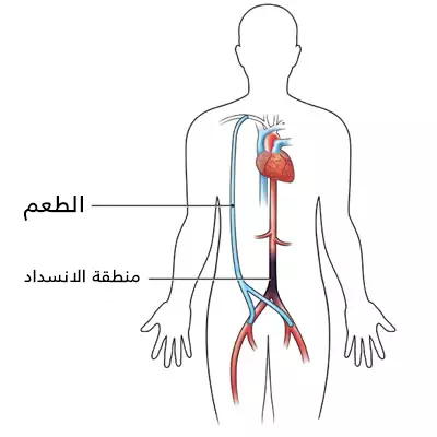 Aksiller femoral baypas, tıkanıklık alanını atlayarak aksiller arteri femoral artere bağlayan bir vasküler grefttir.