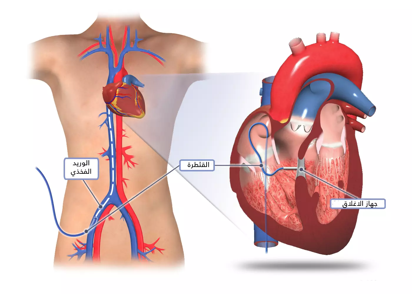 A ventricular septal defect (VSD) is repaired via catheter by inserting a closure device into the hole formed between the ventricles.