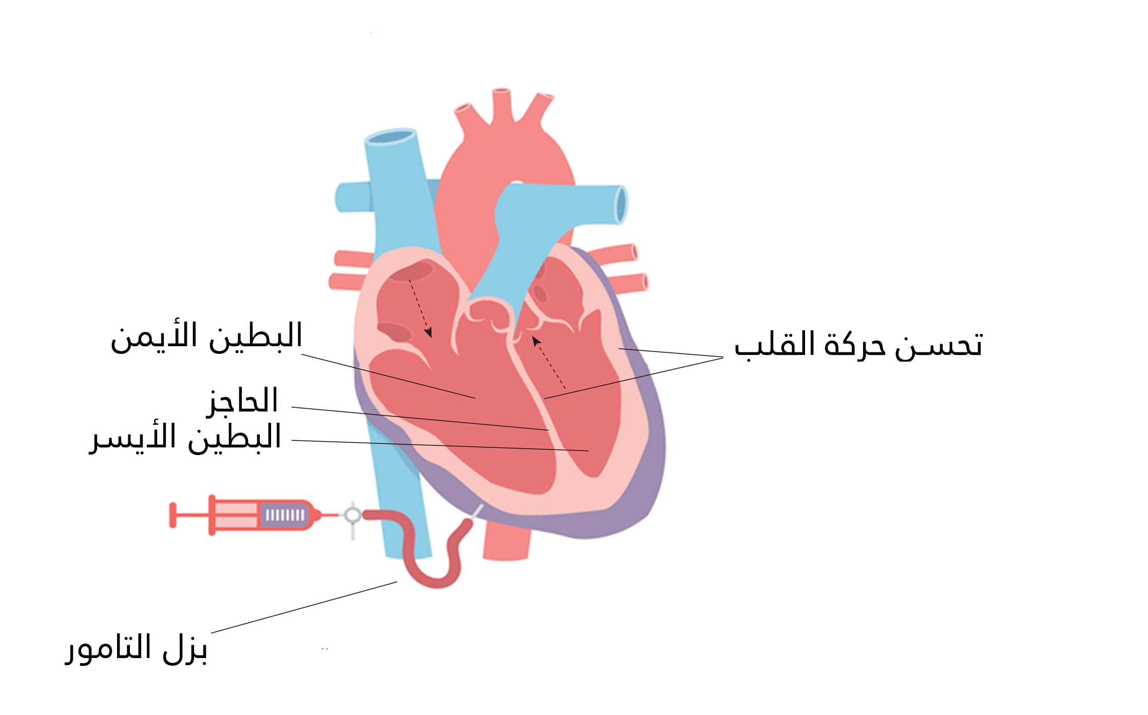تحسن حركة حجرات القلب بعد علاج الانصباب