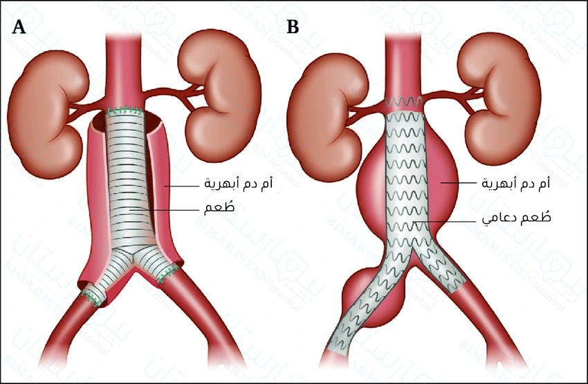 An open surgical stent or stent is placed in order to treat abdominal aortic aneurysm