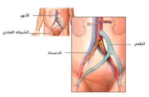 Aort arter baypas ameliyatı