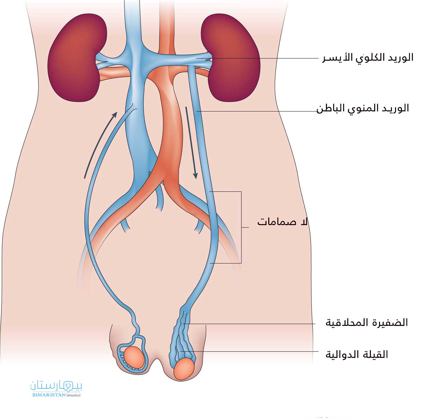 يحدث خلل في عمل الصمامات الموجودة في الوريد المنوي الباطن فيتراكم الدم في الضفيرة المحلاقية التي تتوسع بدورها