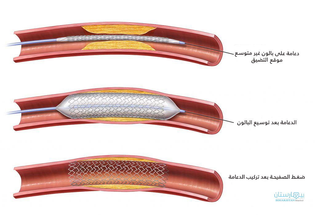 Peripheral arterial catheterization is performed by delivering a stent to the narrowed artery with a catheter, then expanding it with a balloon and then fixing it to the stent