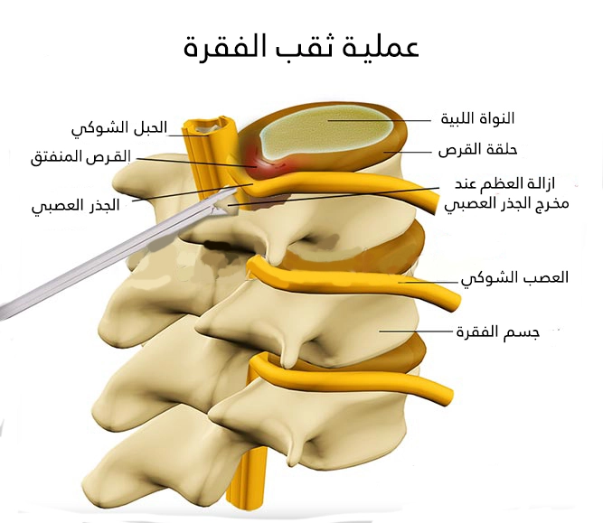 Vertebral puncture is performed in Turkey to remove bony protuberances that press on the nerve roots
