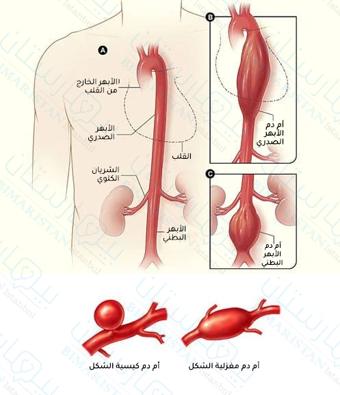 Abdominal aortic aneurysms are divided according to their shape into spindle-shaped and cyst-shaped aneurysms