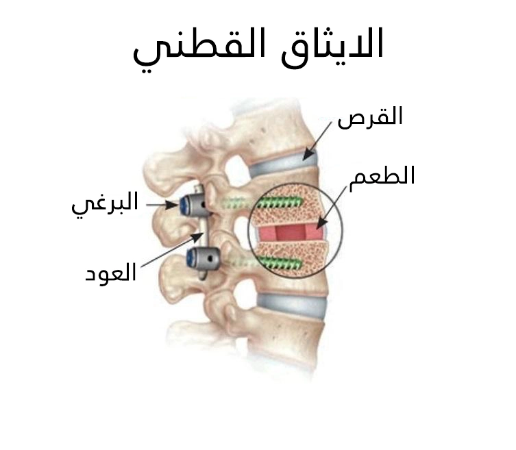 Two successive vertebrae are fused by removing the vertebral plate, installing wires and screws, and replacing the flexible intervertebral disc with a fixed graft