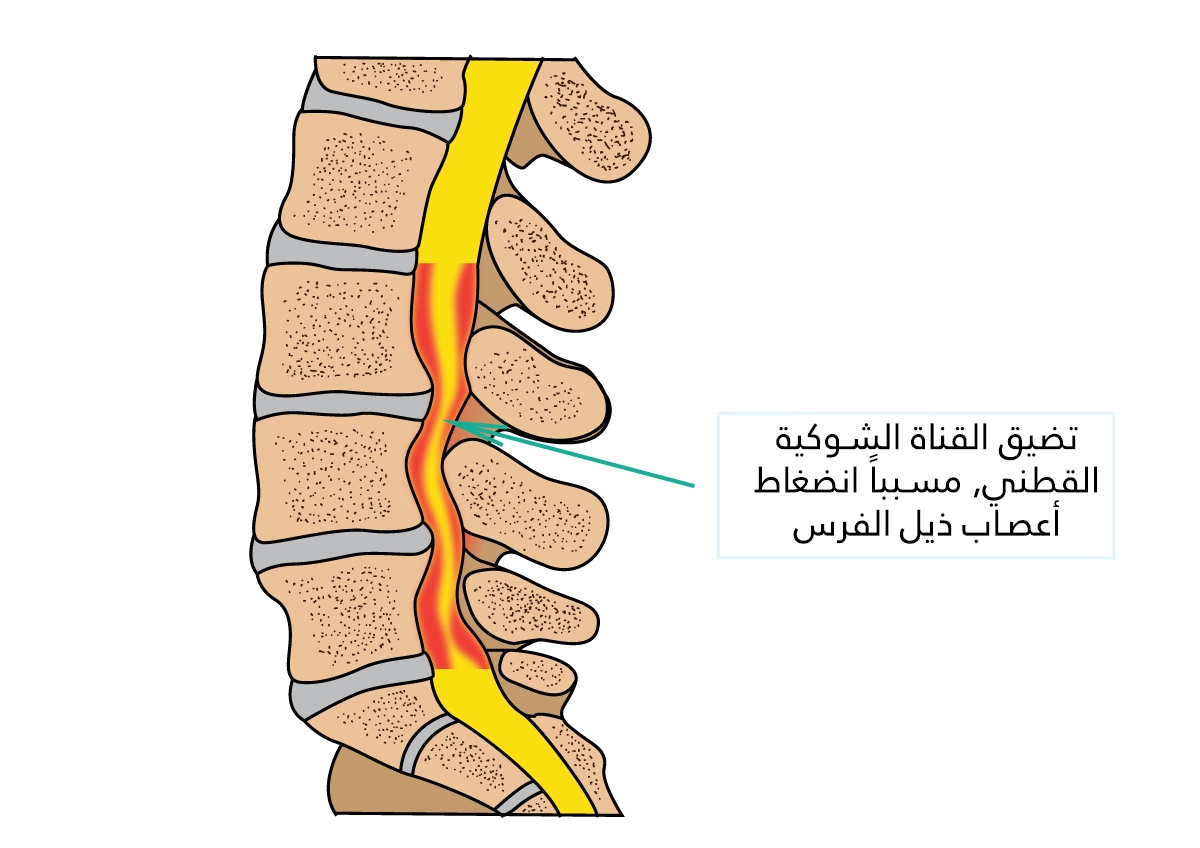 Narrowing of the lumbar spinal canal, causing compression of the cauda equina nerves