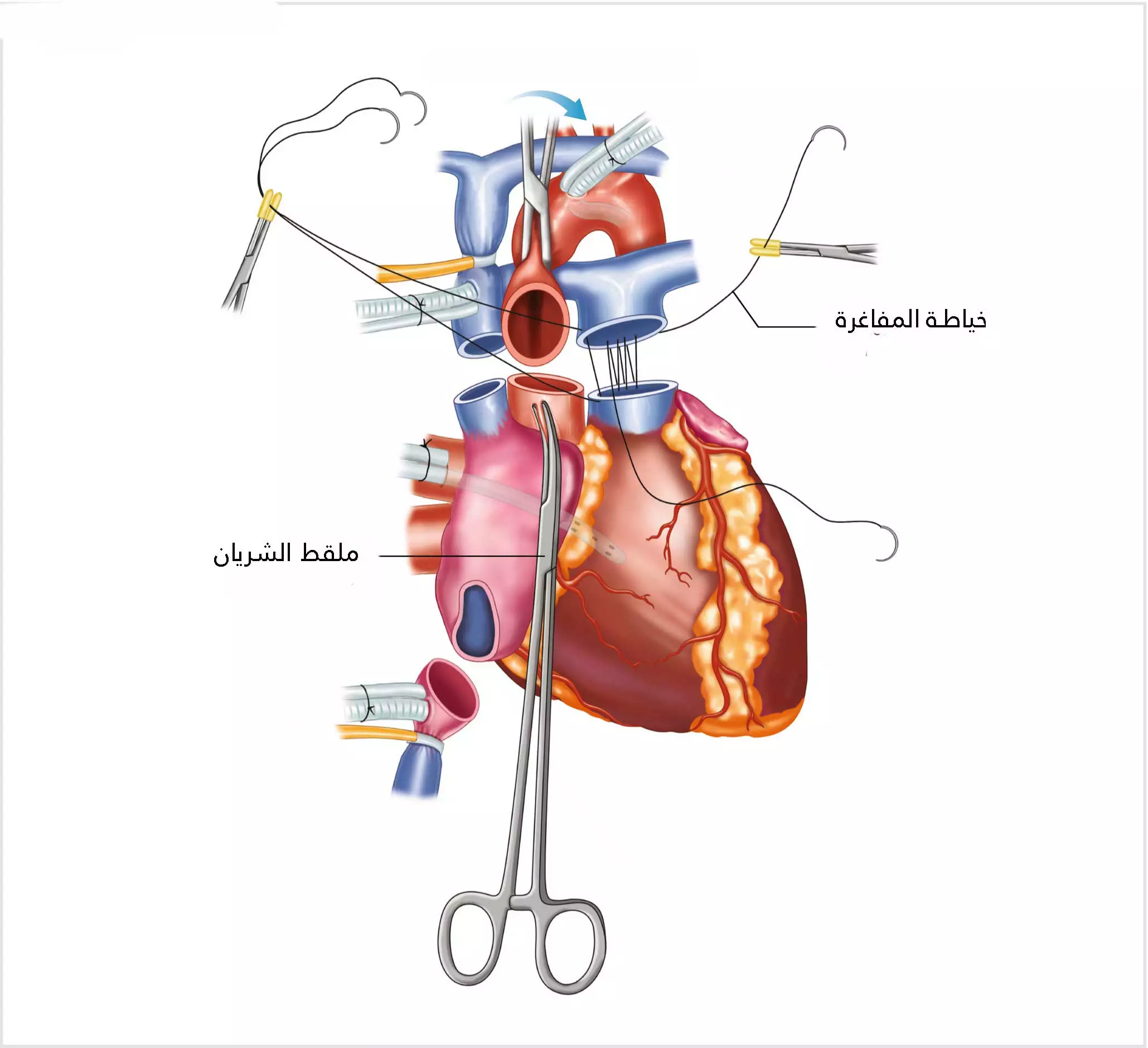 After placing the donated heart in place of the old heart, the arteries and veins are connected in their proper place