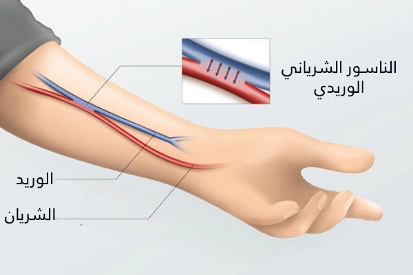 إن تحويلة غسيل الكلى غالباً ما تكون ناسور شرياني وريدي في الساعد