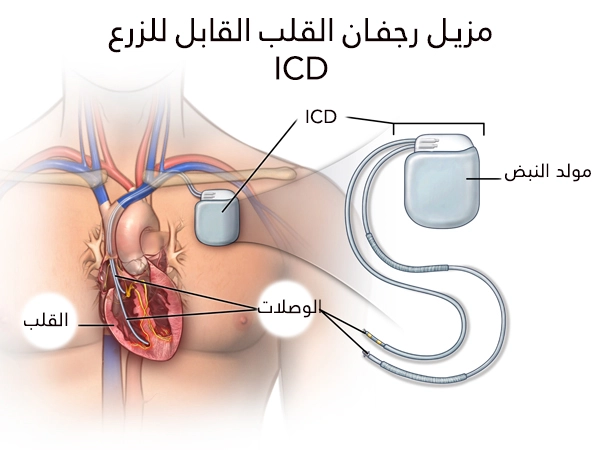 The defibrillator consists of a pulse generator and connections that terminate in the chambers of the heart