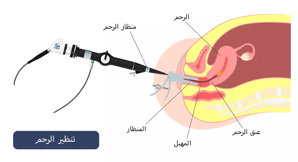 يتم في عملية منظار الرحم توسيع المهبل وإبقاؤه مفتوحاً بواسطة أداة خاصة ثم إدخال منظار الرحم عبر المهبل إلى جوف الرحم