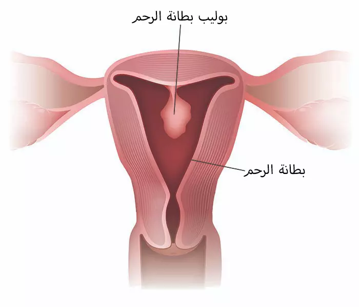 تستخدم عملية تنظير الرحم للكشف عن بوليبات بطانة الرحم وأخذ خزعة منها