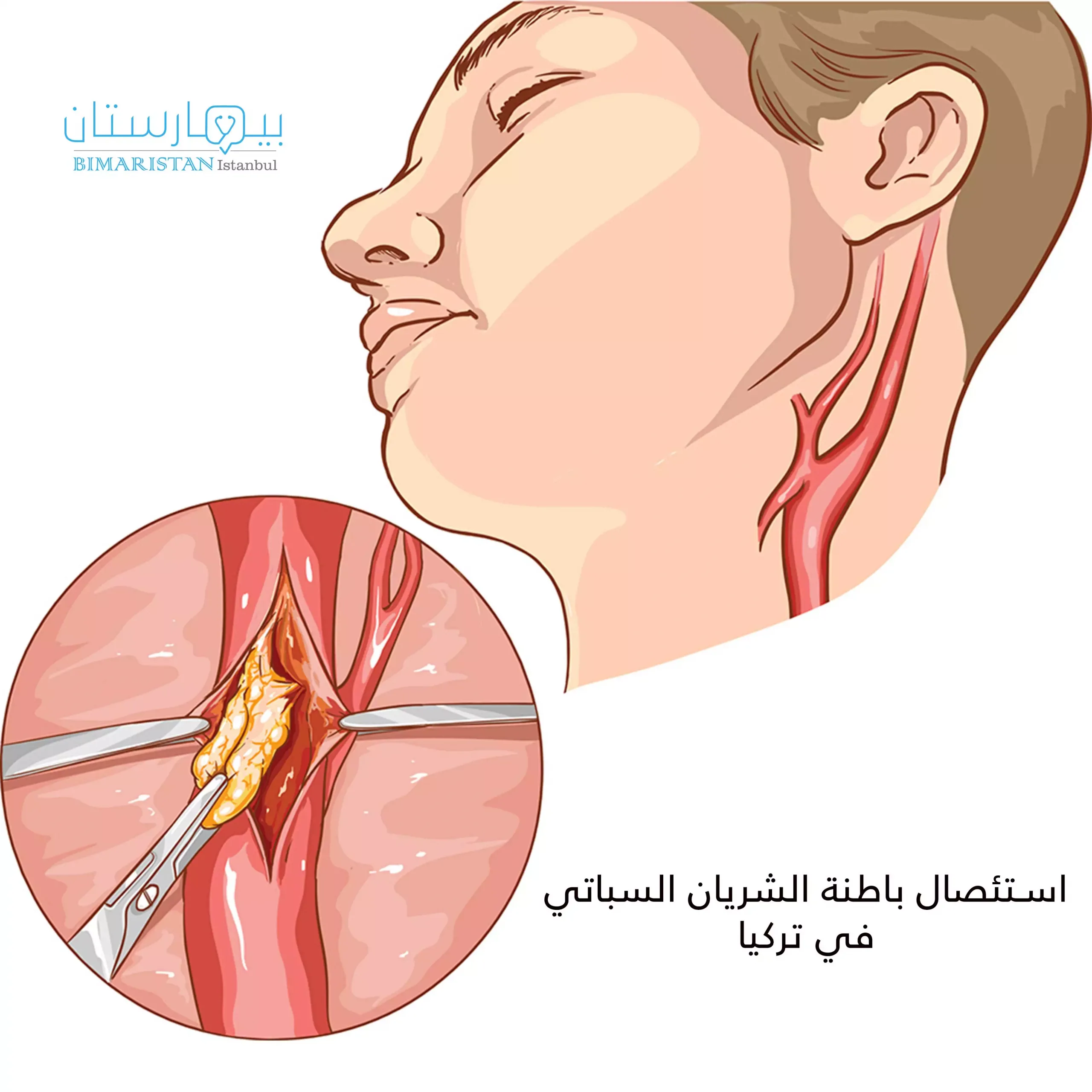 Carotid-artery-endarterectomy