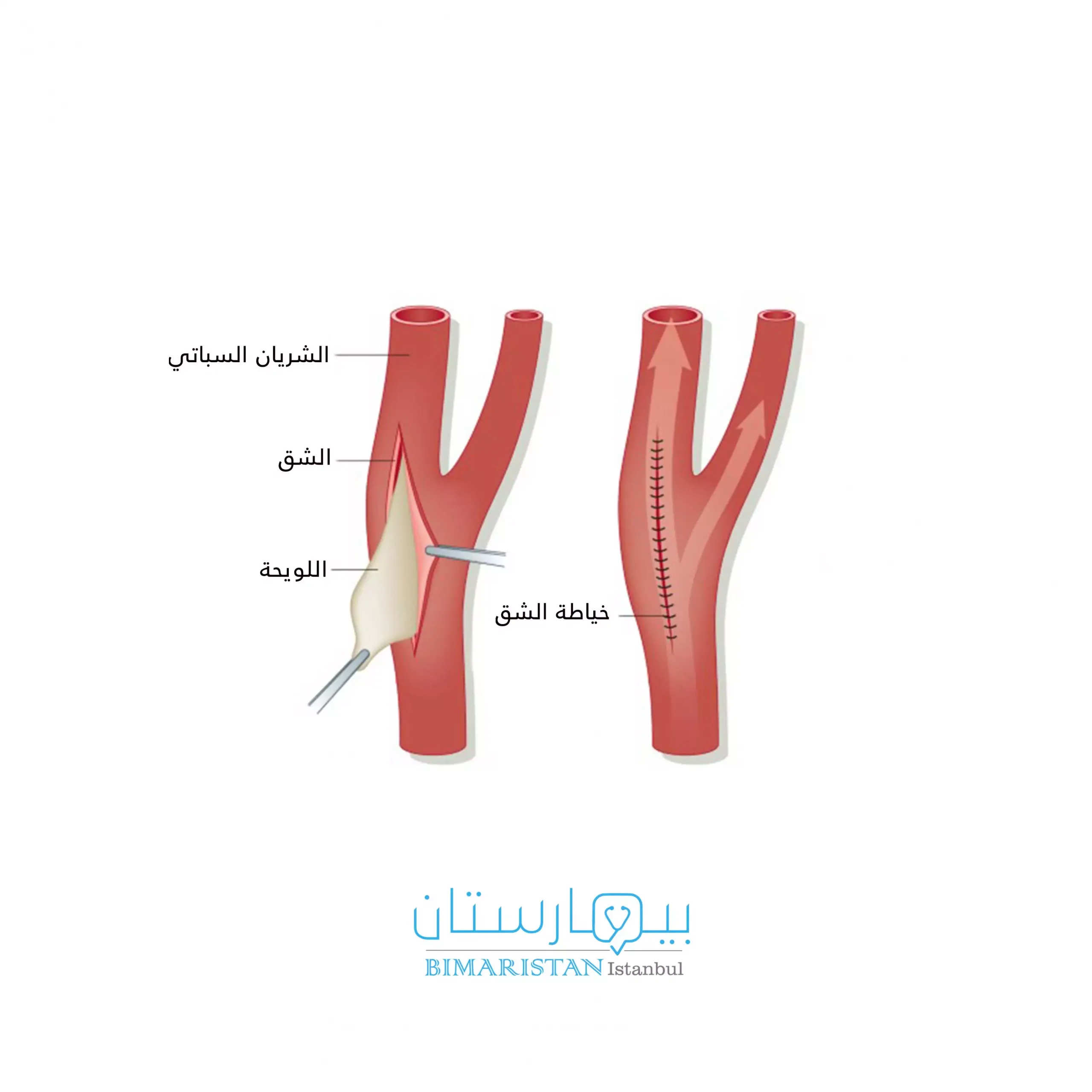 A longitudinal incision is made in the carotid artery, and the atherosclerotic plaque is removed from the endoarteritis