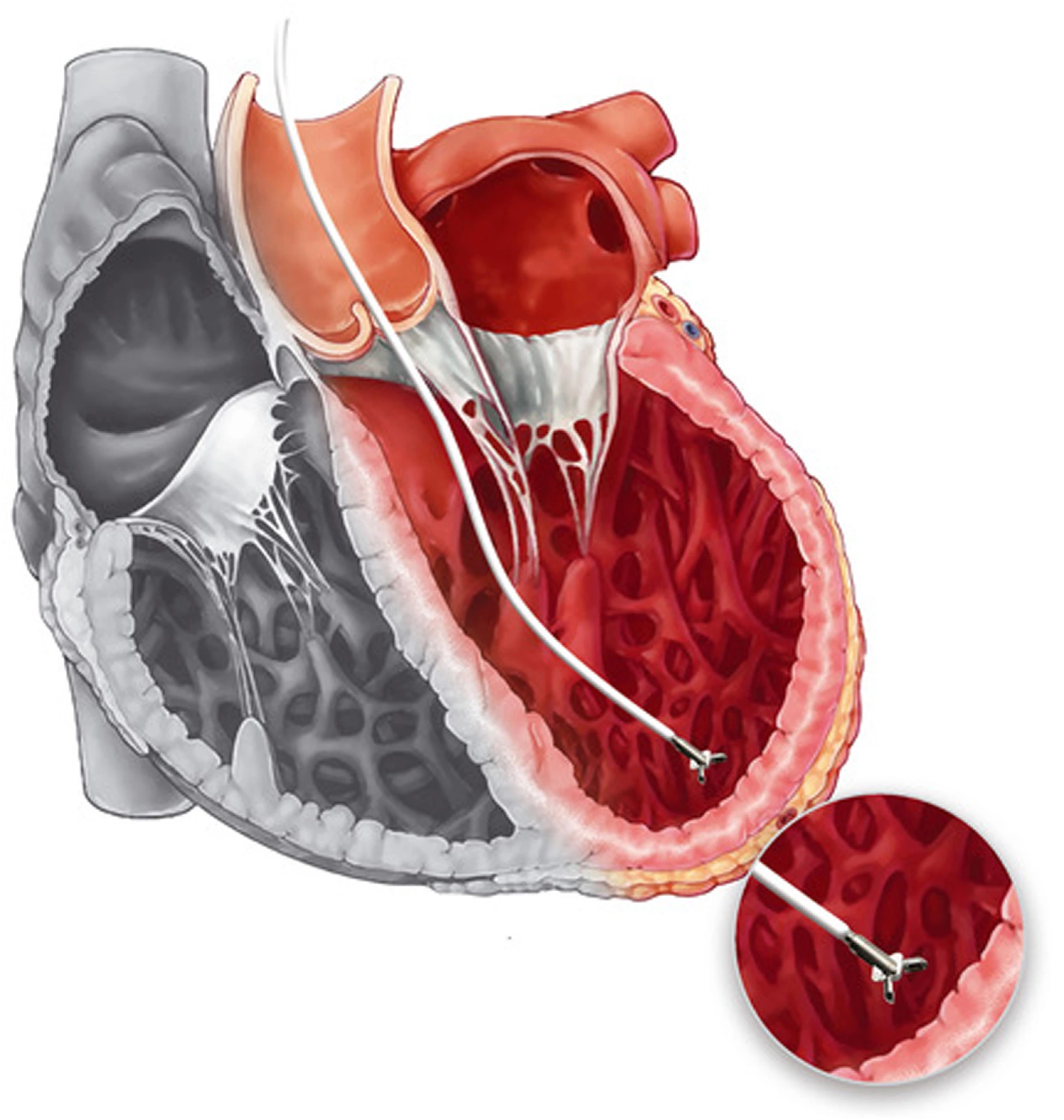 Right heart catheterization with heart tissue biopsy