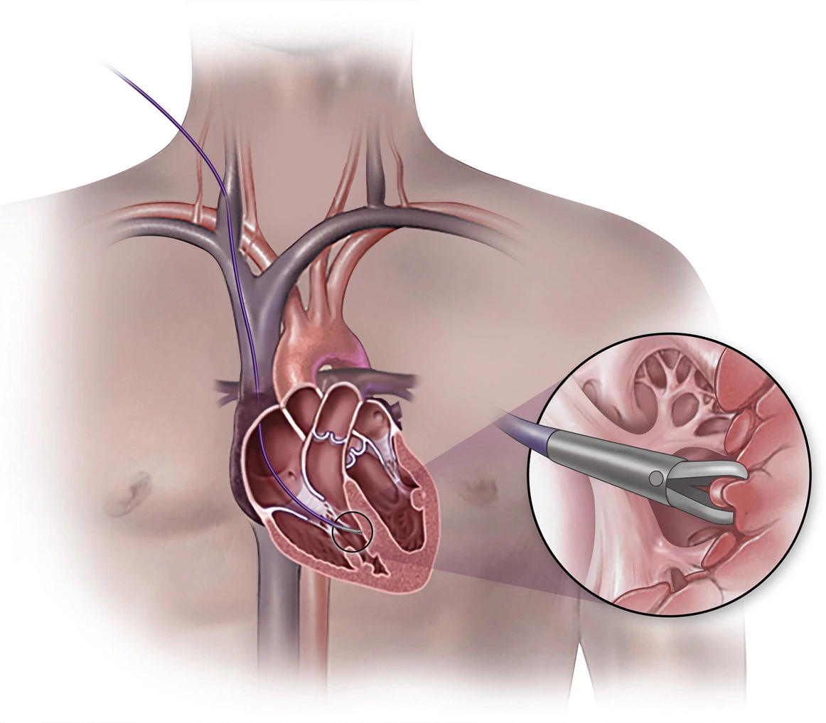 Kalp dokusu biyopsisi ile sağ kalp kateterizasyonu
